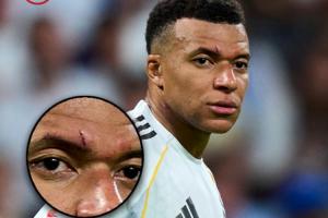 血洒球场！ESPN晒姆巴佩伤口图，伤痕明显有些肿